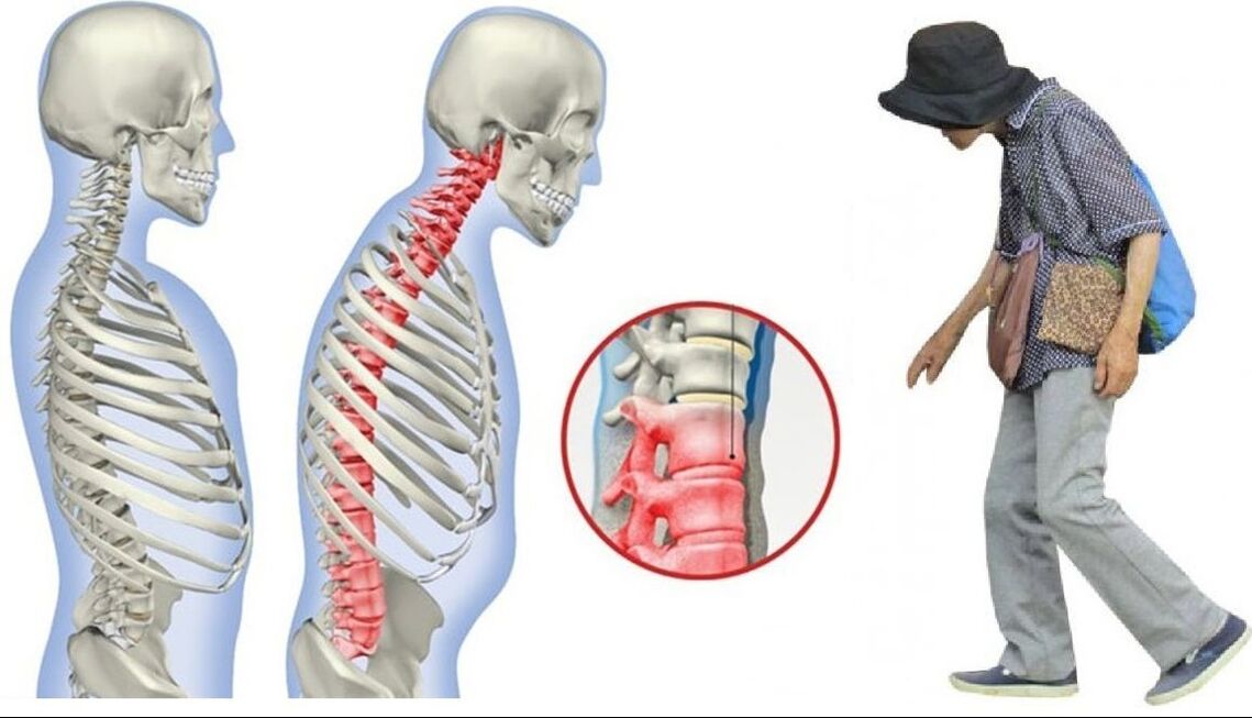 Maux de dos dus à la spondylarthrite ankylosante.